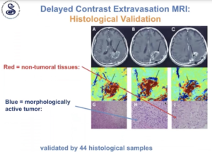 first-clinical-treatments-utilizing-the-automatic-brain-metastases-planning-element