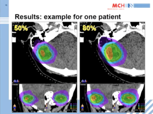 radiosurgery-with-a-higher-tumor-dose-without-a-higher-normal-tissue-geud