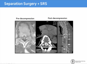 Local Disease Control for Spinal Metastases Following “Separation Surgery” and Adjuvant SRS