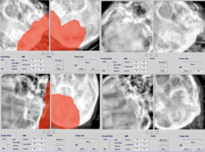 frameless-based-image-guided-radiosurgery-igrs-of-trigeminal-neuralgia-using-novalis-exactrac-system