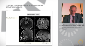 Clinical Experience with Intra-Operative Structure Update