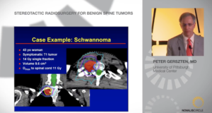 Stereotactic Radiosurgery for Benign Spine Tumors
