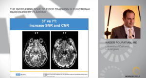 the-increasing-role-of-fiber-tracking-in-functional-radiosurgery-planning