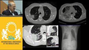 Novalis-based SBRT for Lung Malignancies: Normal Tissue Toxicity and Clinical Outcomes