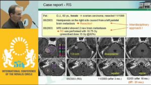Survival Time After RS and hfSRT of Brain Metastases