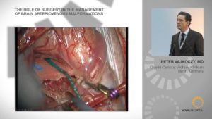 The Role of Surgery in the Management of Brain Arteriovenous Malformations