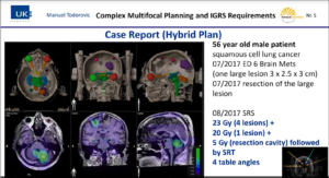 complex-multifocal-planning-and-igrs-requirements