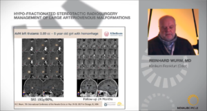 Hypo-Fractionated Stereotactic Radiosurgery Management of Large Arteriovenous Malformations