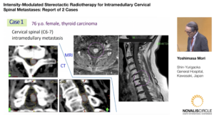 Intensity-Modulated Stereotactic Radiotherapy for Intramedullary Cervical Spinal Metastases: Report of 2 Cases
