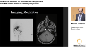 AVM Nidus Definition via Planar DSA Co-Registration with MRI-based Maximum Intensity Projections
