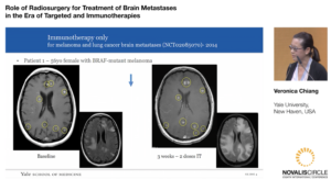 role-of-radiosurgery-for-treatment-of-brain-metastases-in-the-era-of-targeted-and-immunotherapies