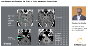 how-research-is-breaking-the-rules-of-brain-metastasis-patient-care