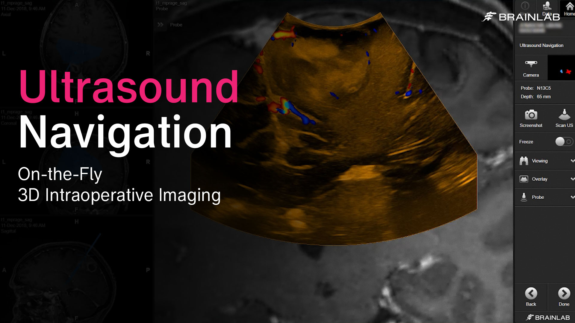 Brainlab Video Ultrasound Navigation Live Intraoperative Imaging