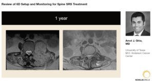 review-of-6d-setup-and-monitoring-for-spine-srs-treatment
