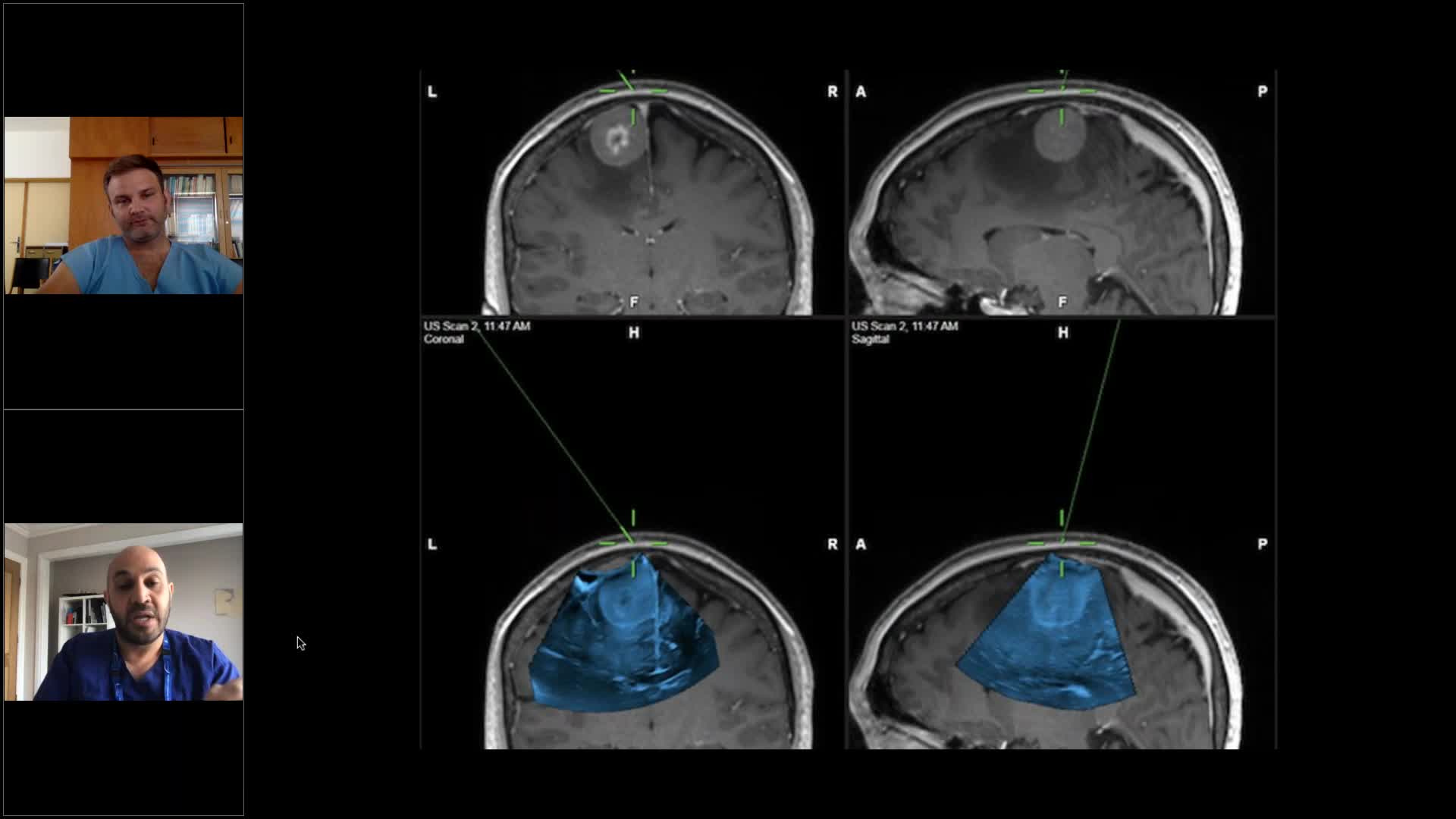 Brainlab Video - Navigated Ultrasound In Neurosurgery Ask The Experts