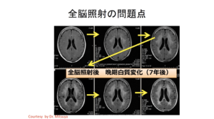 静岡がんセンターにおける転移性脳腫瘍の治療戦略の変遷 / History of Treatment Strategy against Brain Metastases at Shizuoka Cancer Center