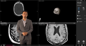 Multiple Brain Metastases SRS for small targets – simple case