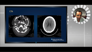 Case of the month webinar: frameless radiosurgery for arteriovenous malformations