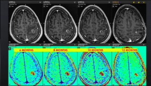 Targets, tracts, tumors and trouble – Why Brainlab is an essential element for a successful brain radiosurgery program