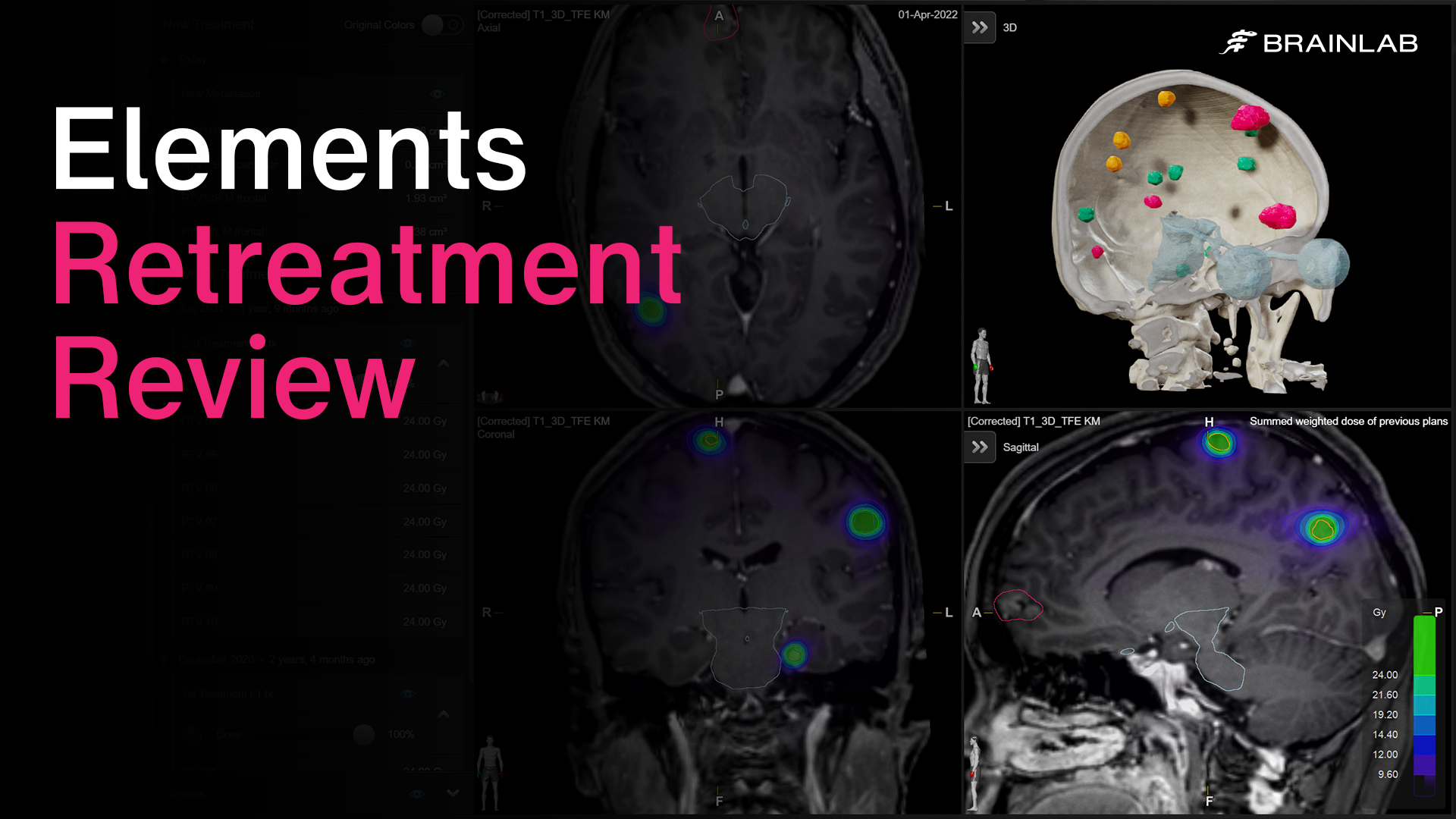 Elements Multiple Brain Mets SRSを使用した単発/多発性転移性