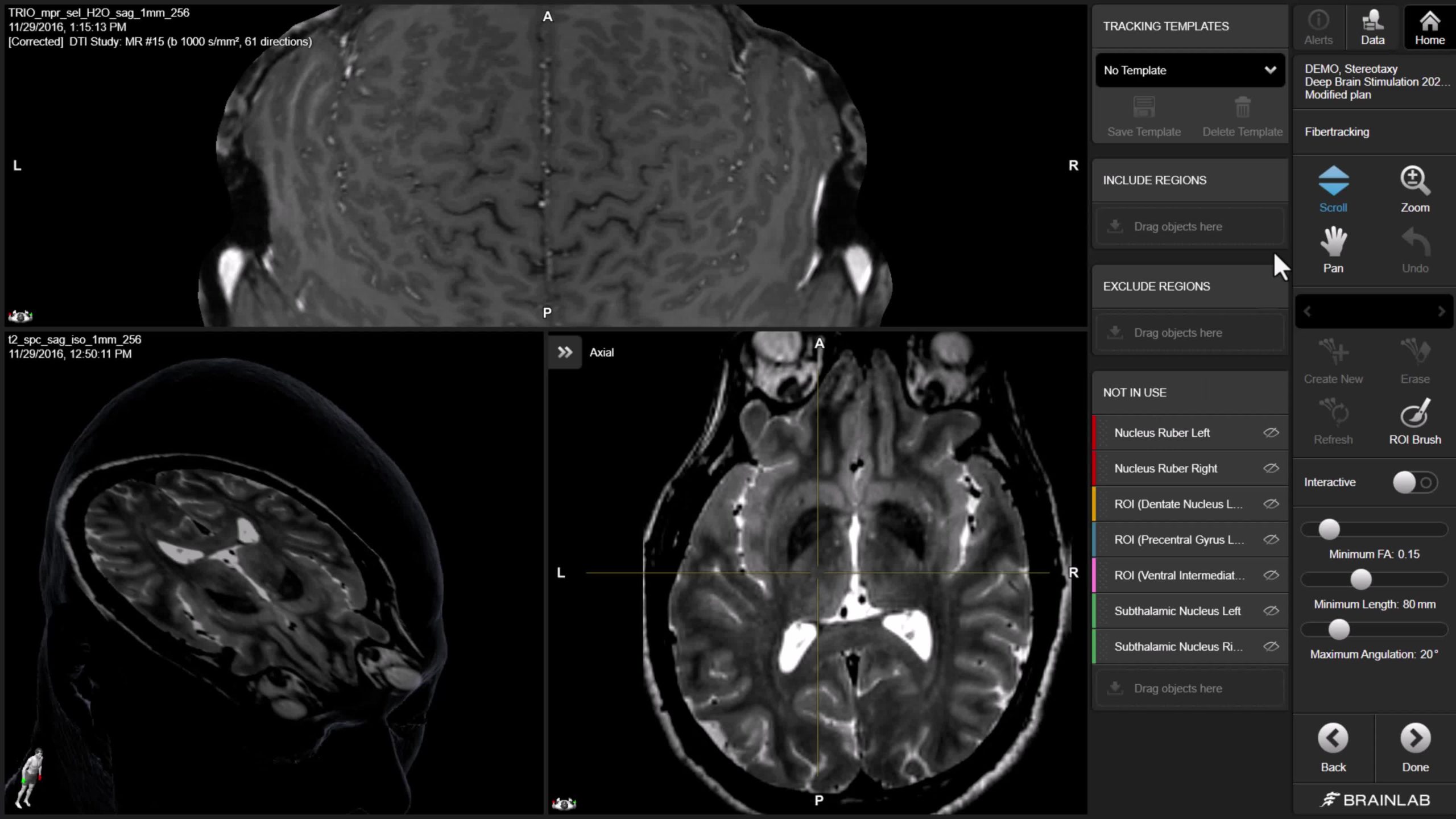 Решения для планирования - Brainlab