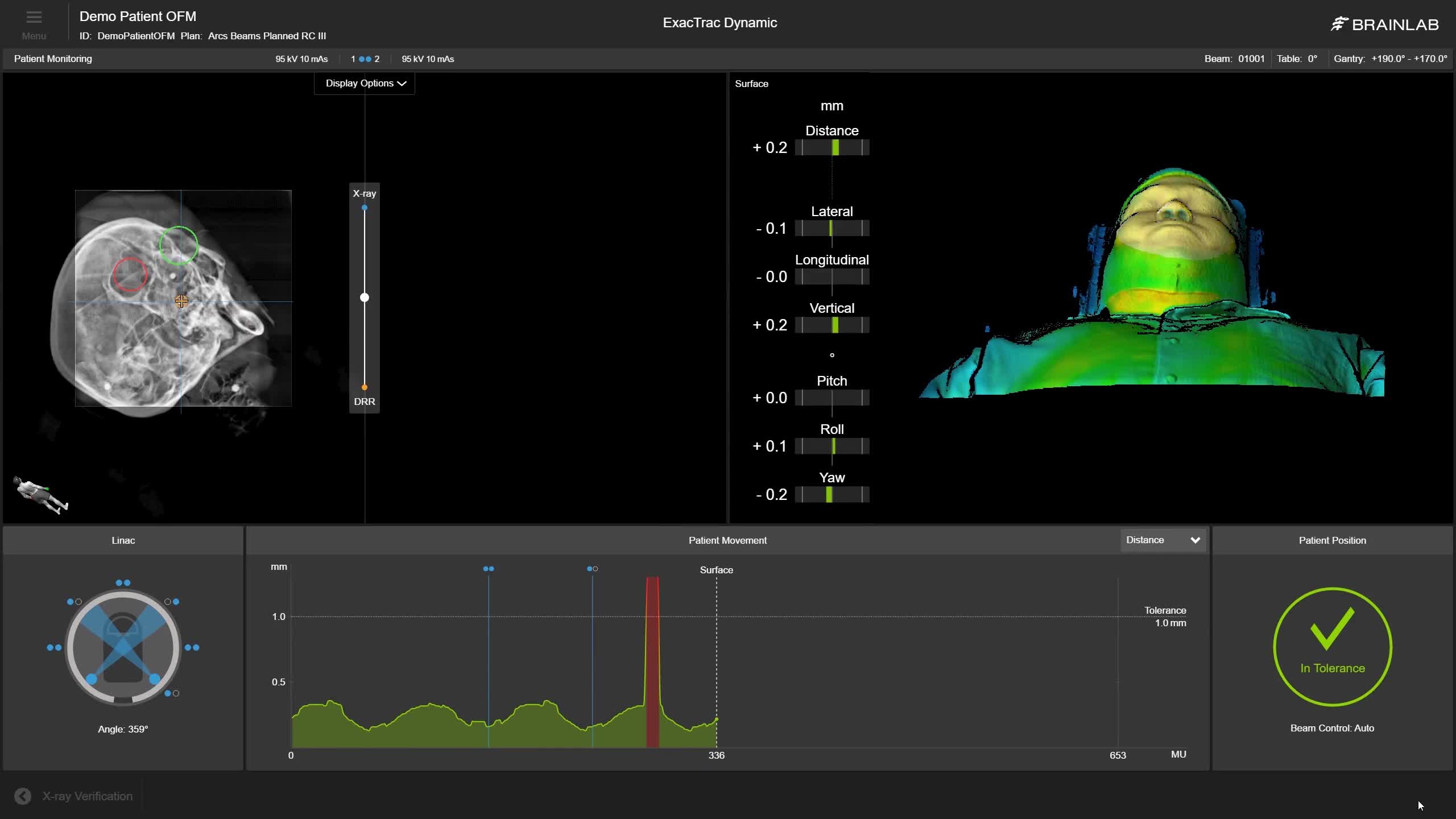 Cranial and Spine SRS & SBRT with ExacTrac Dynamic