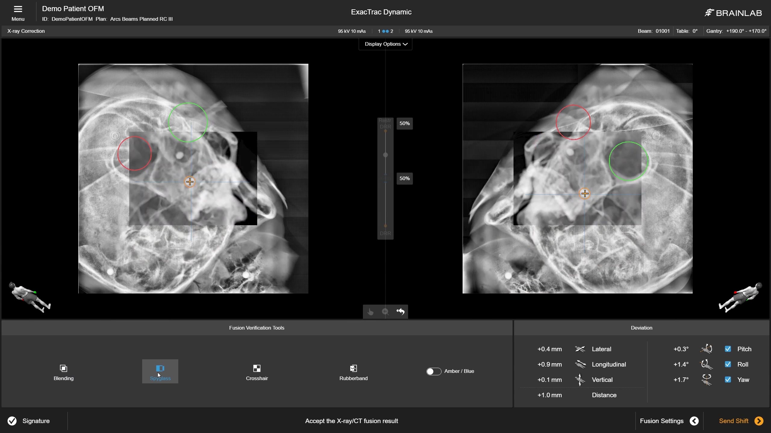 exactrac-dynamic-for-multiple-brain-metastases-feature-2-mp4
