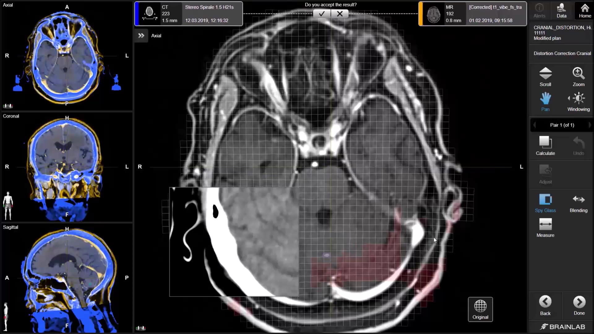 rt-elements-multiple-brain-mets-distortion-correction-background-mp4