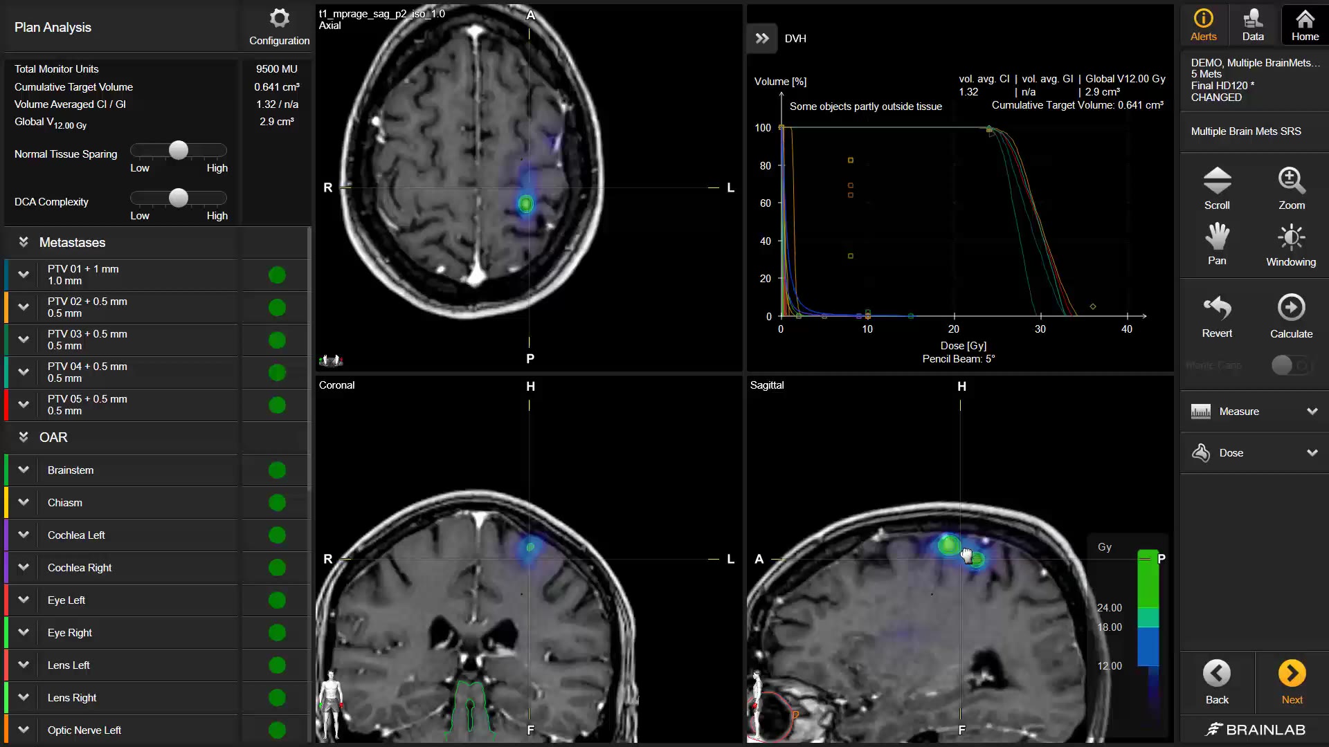 rt-elements-multiple-brain-mets-optimizing-planning-outcome-background-mp4