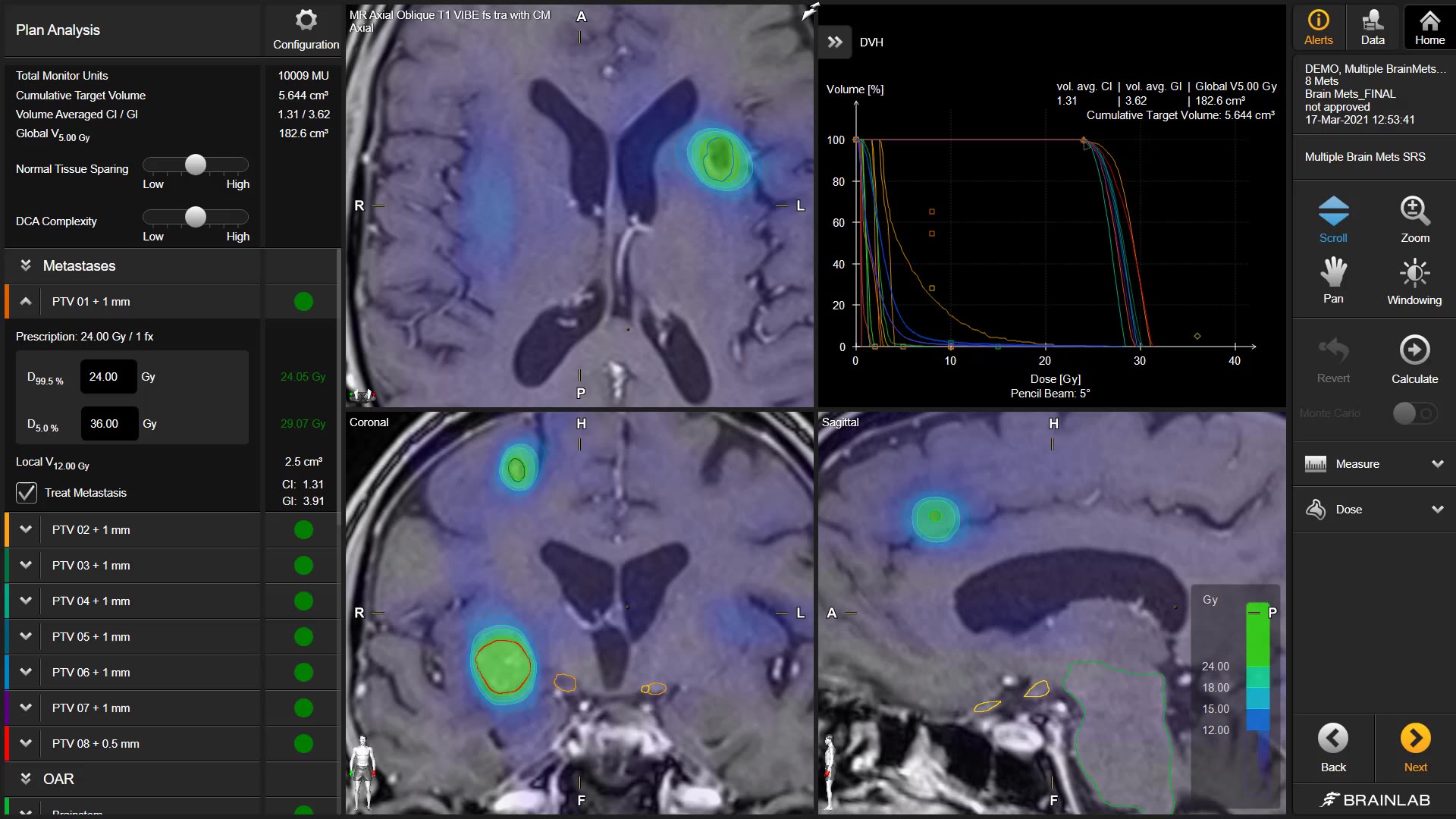rt-elements-multiple-brain-mets-simplified-plan-analysis-background-mp4