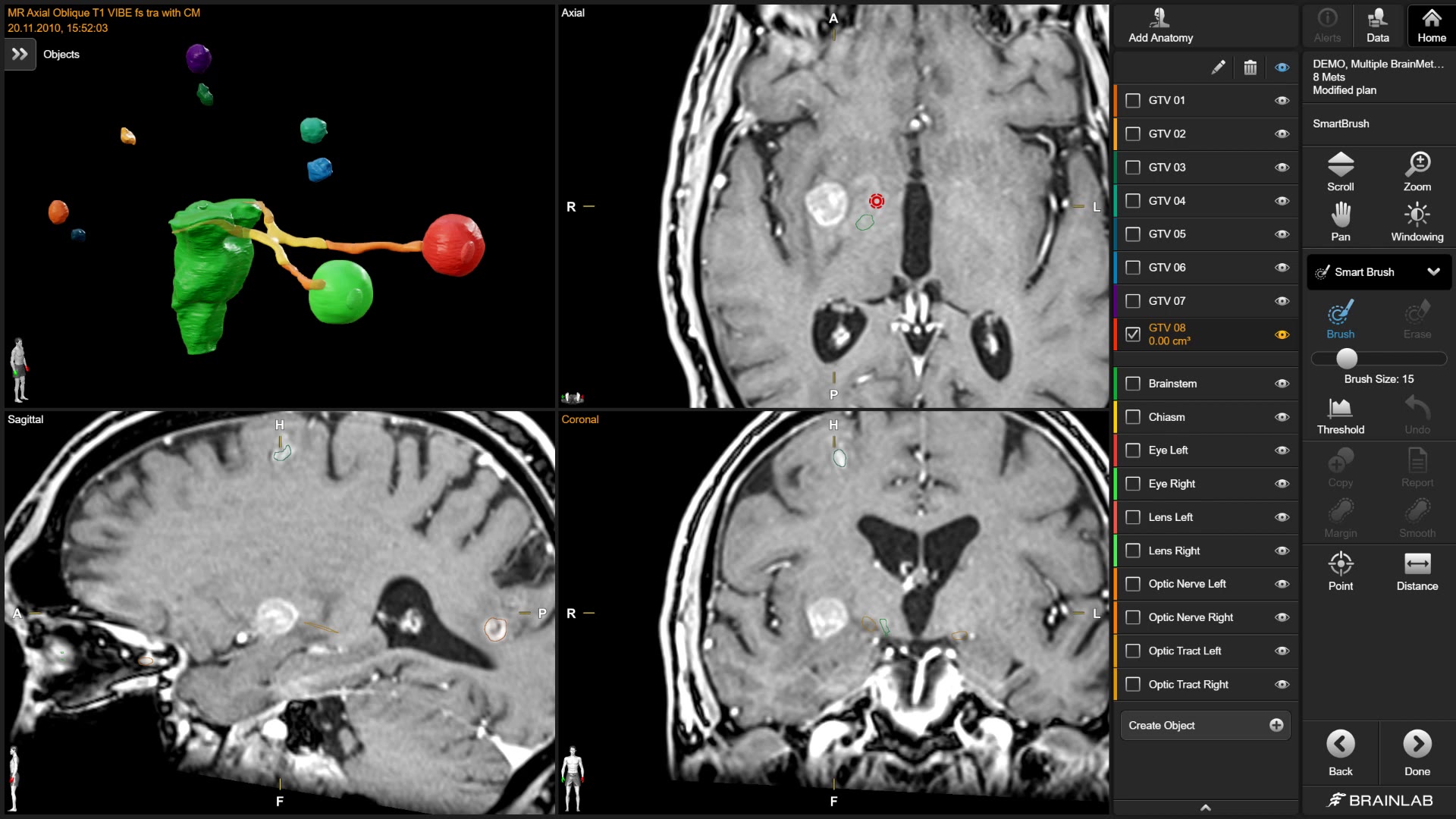 rt-elements-multiple-brain-mets-smartbrush-background-mp4
