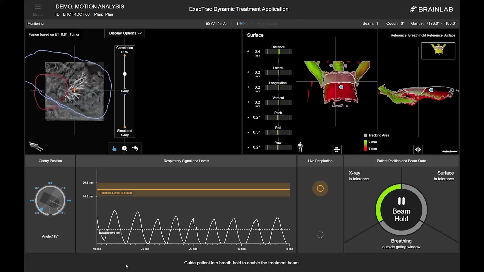 lung-monitoring-and-repositioning-mp4